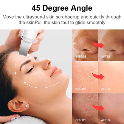 Ultrasonic Exfoliating Wand